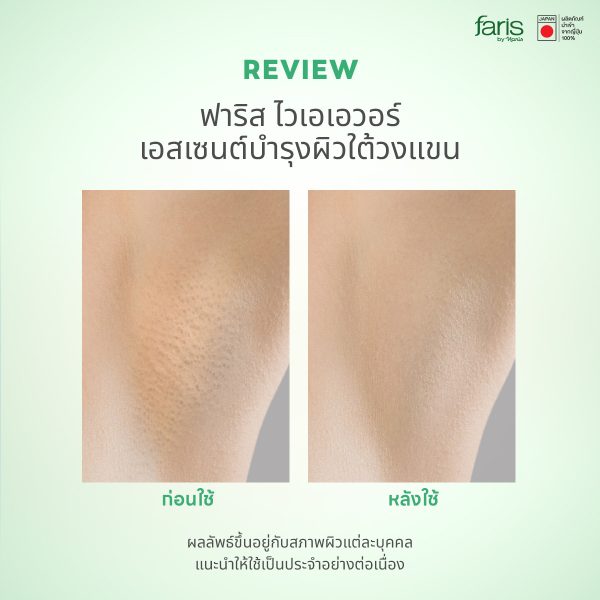 บอกลาปัญหารักแร้ดำ ตุ่มหนังไก่ รักแร้กระจ่างใส ไม่ต้องพึ่งเลเซอร์!