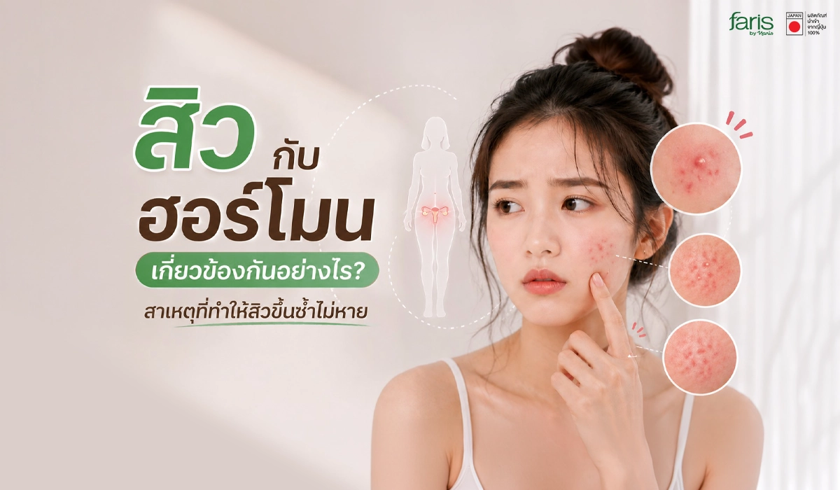 ผู้หญิงแตะบริเวณแก้มที่มีสิวอักเสบ พร้อมกราฟิกแสดงระบบฮอร์โมนในร่างกาย สื่อถึงความสัมพันธ์ระหว่างฮอร์โมนกับการเกิดสิวที่ขึ้นซ้ำในช่วงเดิมทุกเดือน
